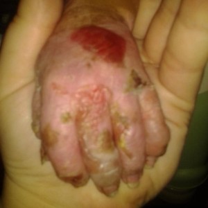 Ben Wiley Jr.'s Blistered Hand