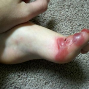 Blistered Toe
