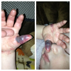 Brystal's Bruised and Blistered Thumb