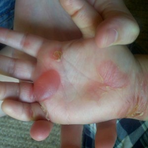 Gabriel's Blistered Hand