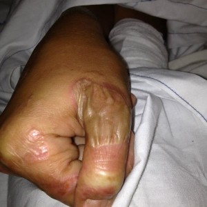 Jonathon's infected hand.