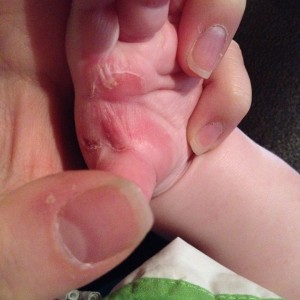 Lane's hand with blisters.