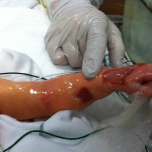 Liam's Arm After Birth
