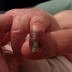 Teagyn's blistered finger.